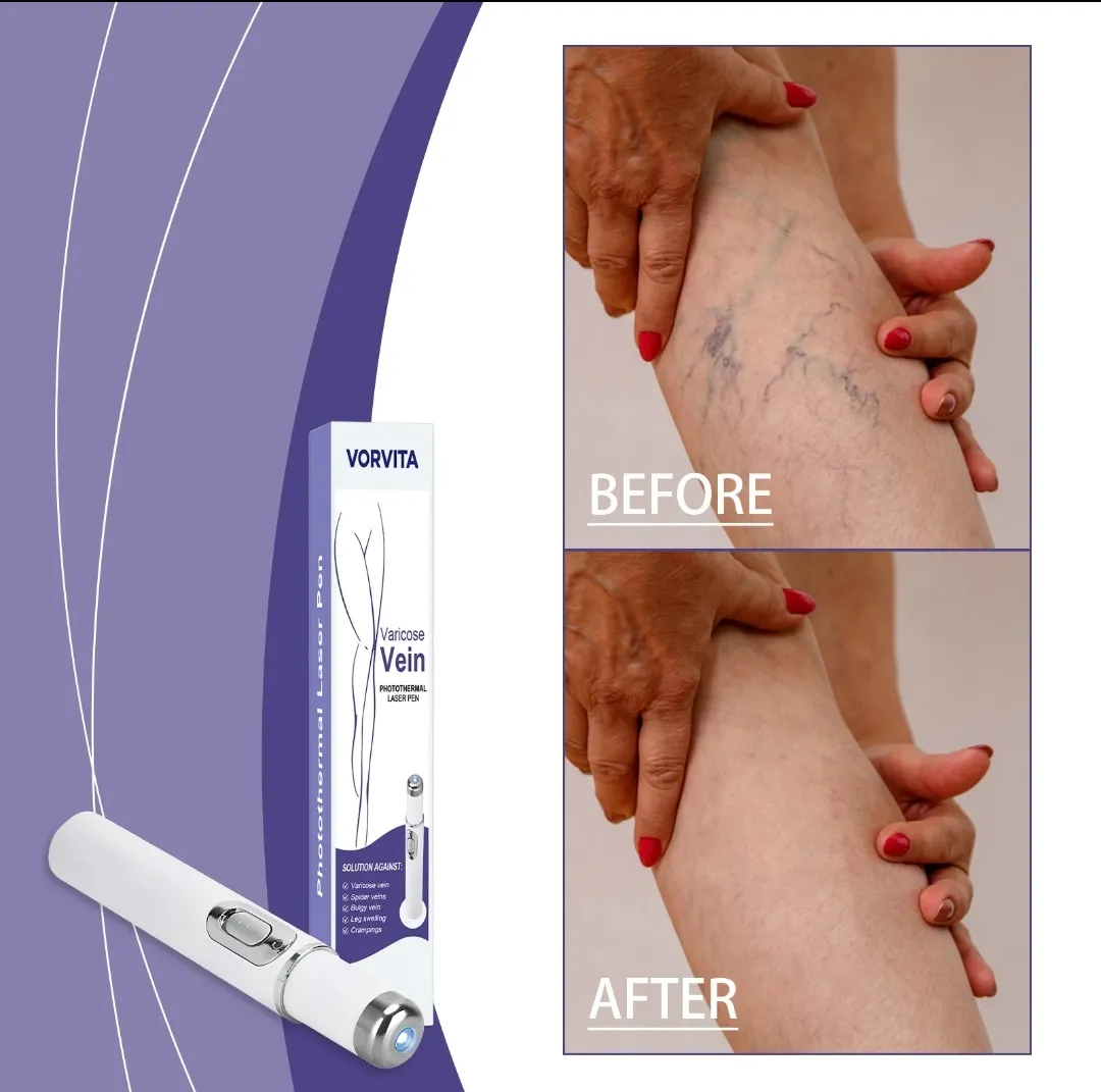 Vorvita Varicose Vein Pen - Image 2