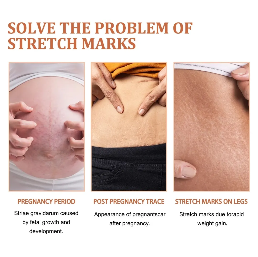 eelhoe Stretch Marks Removal Cream - Image 3
