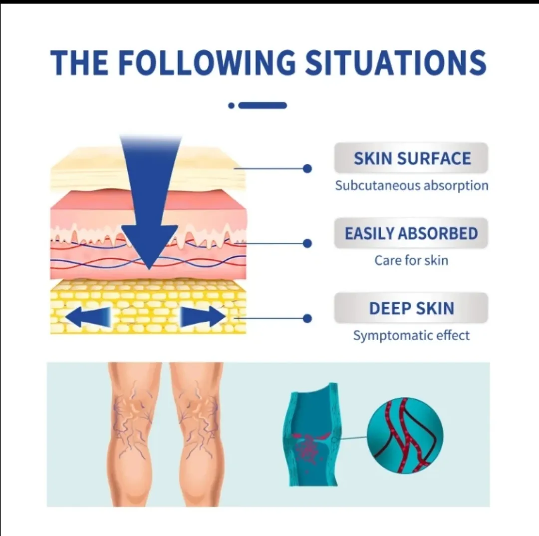Varicose Vein Cream - Image 2