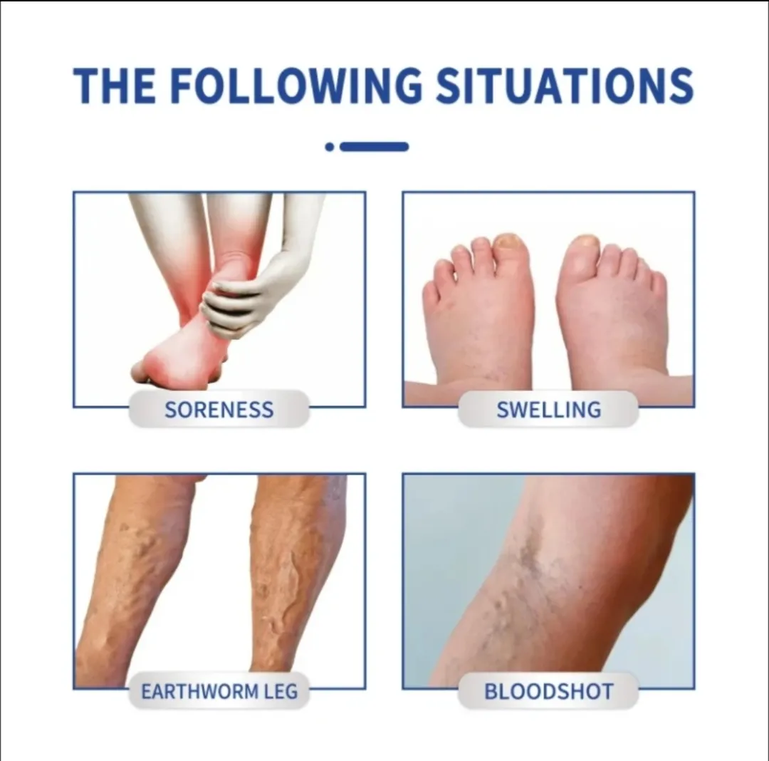 Varicose Vein Cream - Image 3